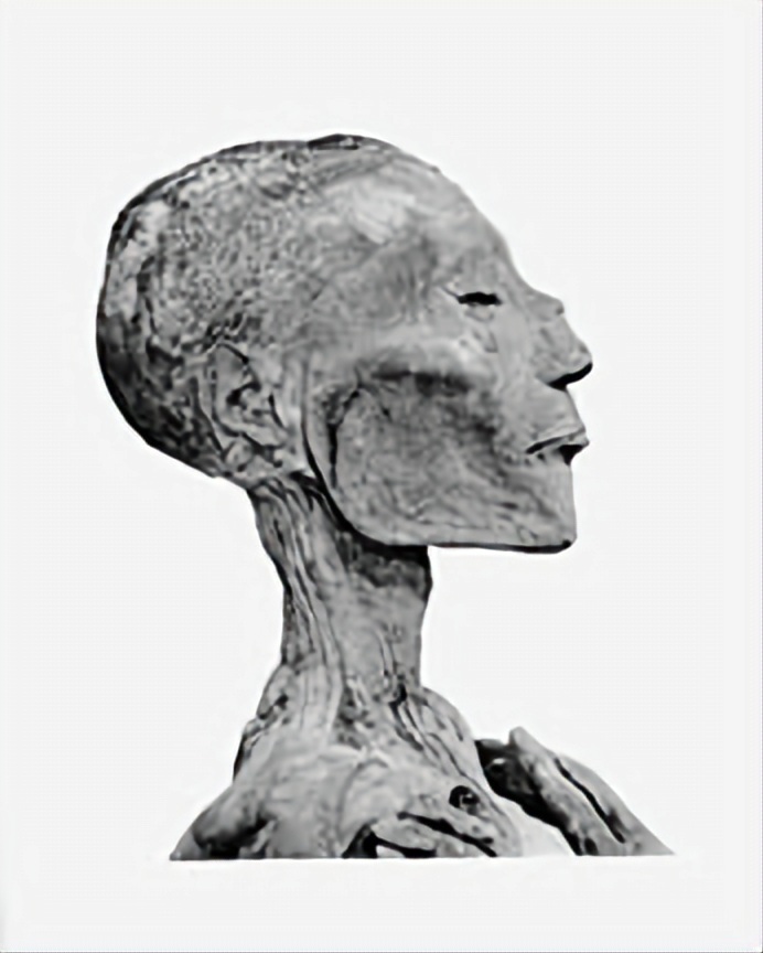 smallpox_mummy_showed_evidence_of_infection